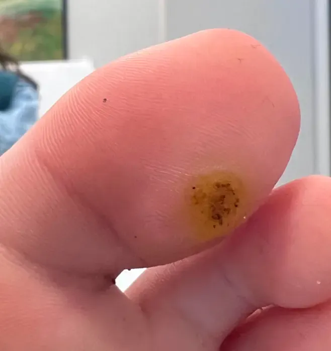 Tengo Verrugas Plantares