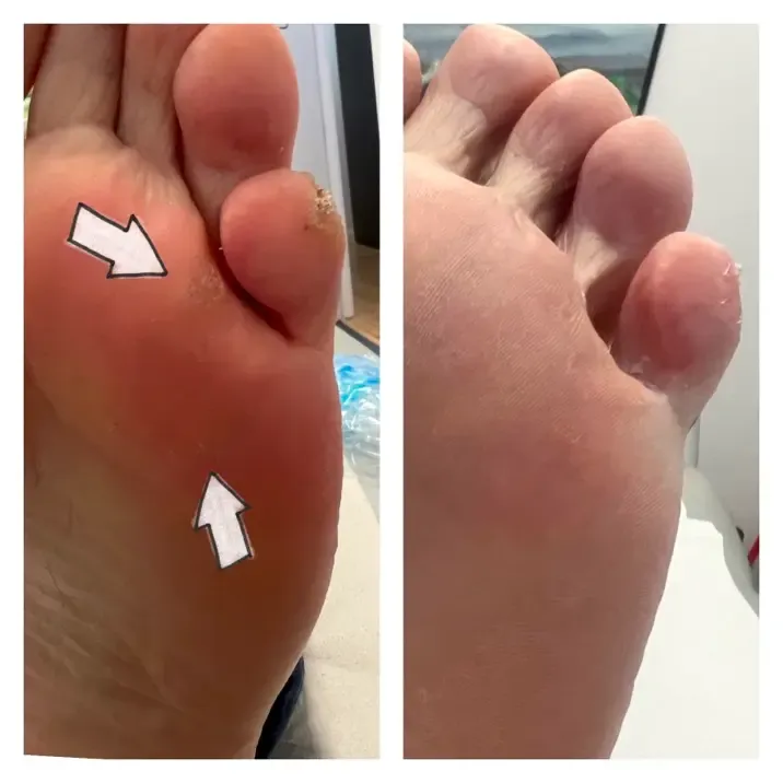 Tengo Verrugas Plantares