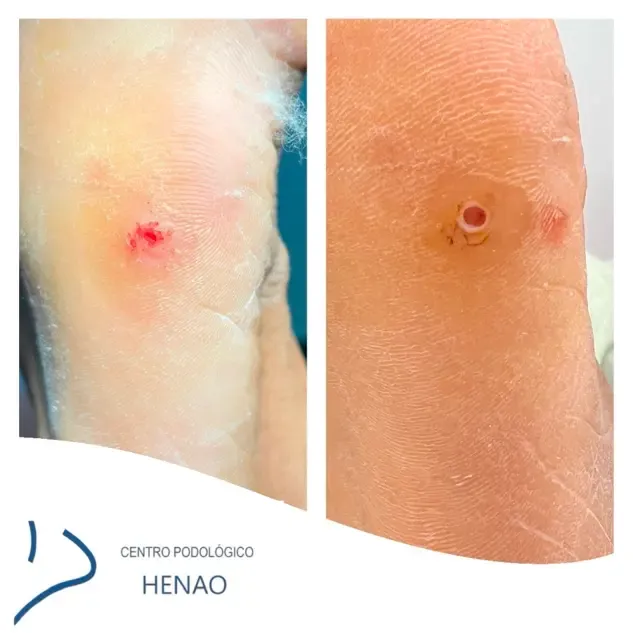 Tengo Verrugas Plantares