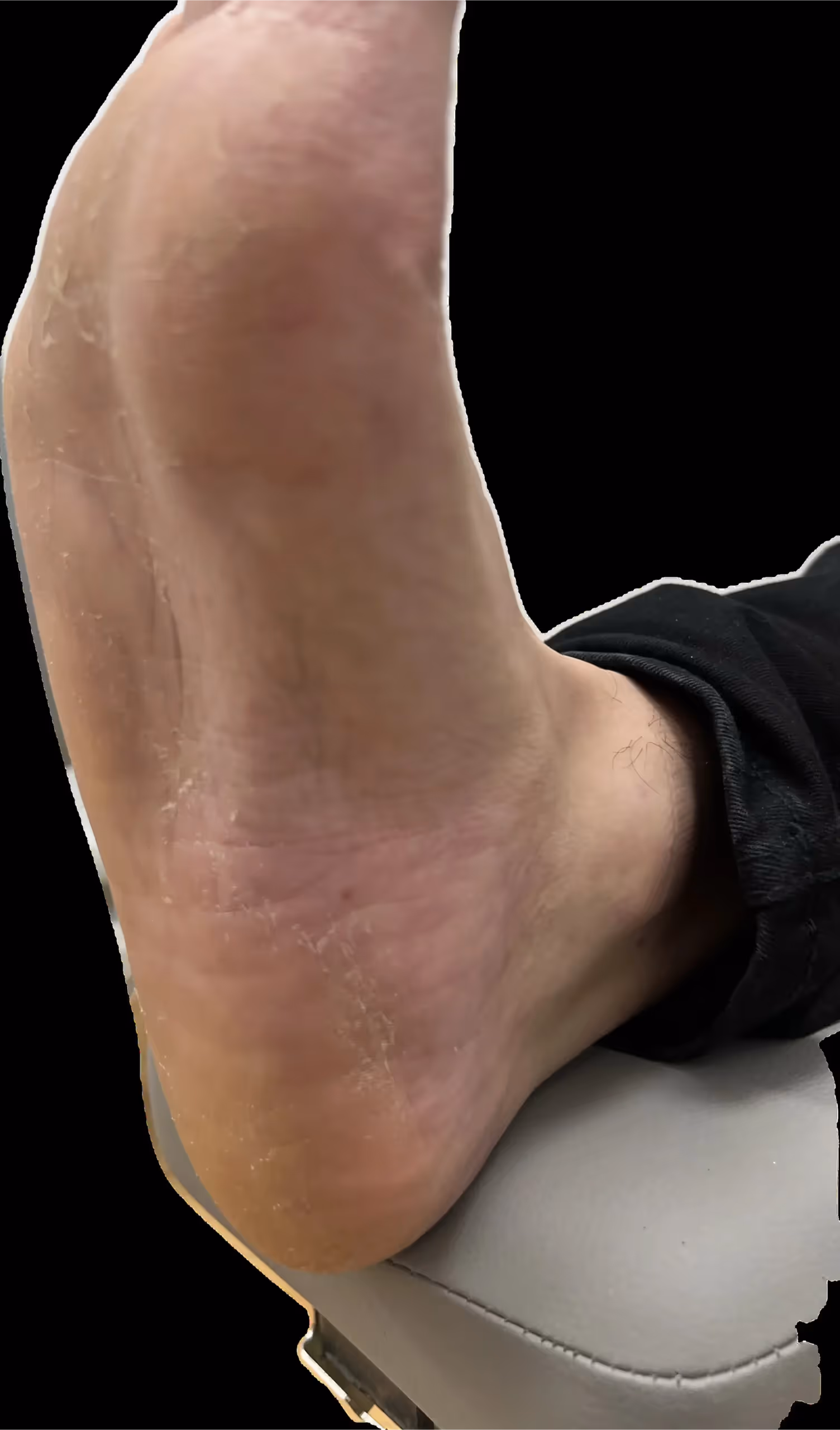 Caso clínico de hongos en los pies tratado con láser en Centro Podológico Henao