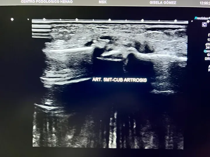 Plantillas ortopédicas personalizadas diseñadas para redistribuir cargas en pie con artrosis