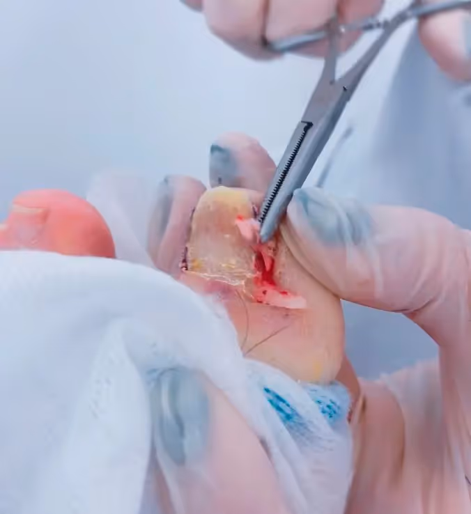 Caso clínico de uña encarnada en Centro Podológico Henao Bilbao