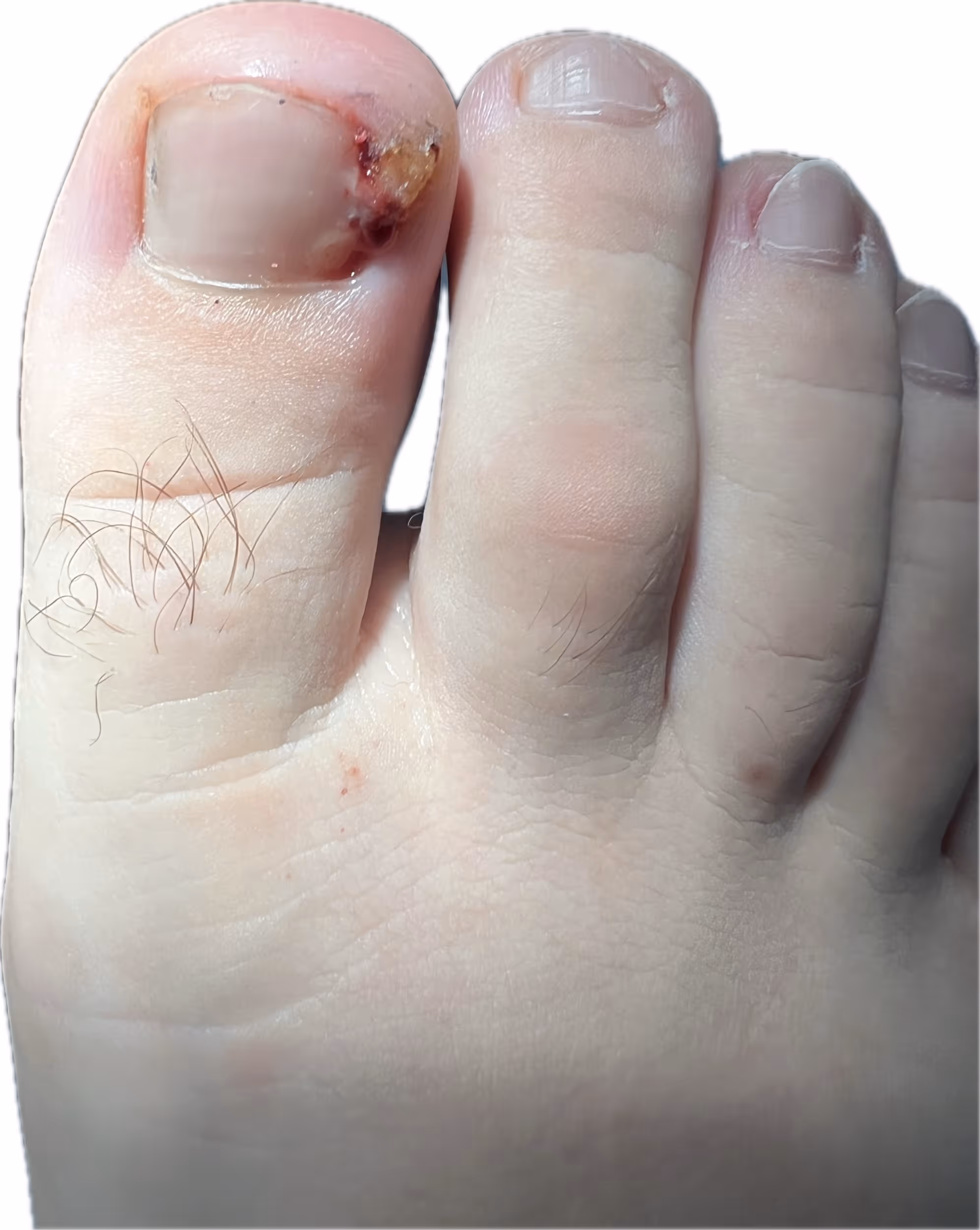 Uña encarnada antes del tratamiento - Centro Podológico Henao