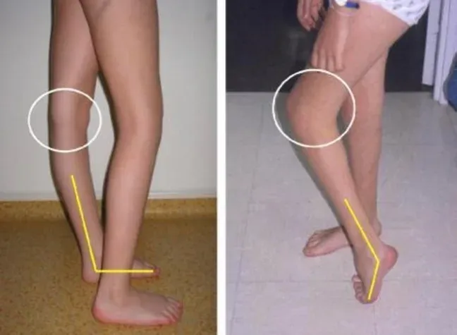 Exploración de piernas con genu valgum y pronación valorada en Centro Podológico Henao, Bilbao