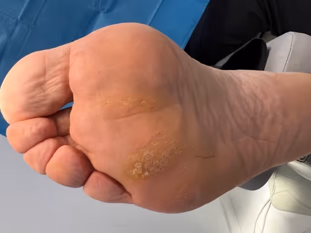 Verruga plantar en mosaico antes del tratamiento con técnica Falknor en Centro Podológico Henao Bilbao