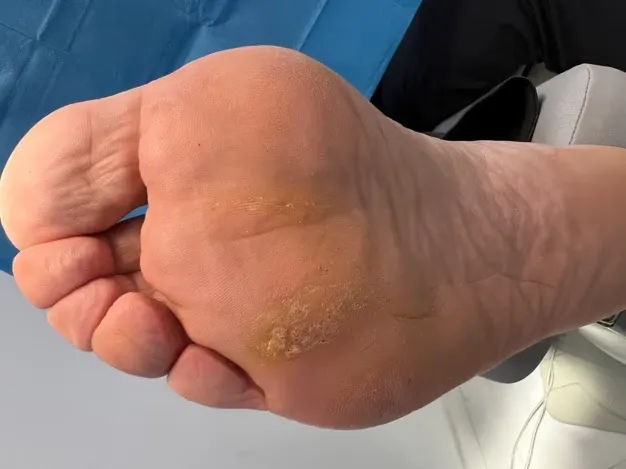 Verruga plantar en mosaico antes del tratamiento con técnica Falknor en Centro Podológico Henao Bilbao